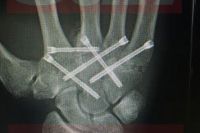 Хан перенёс операцию на руке