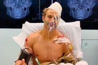 Сэйдж Норткатт перенес 9-часовую операцию после 8 переломов лицевых костей