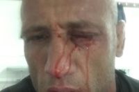 Александру Бутенко сделали операцию, его глаз весь в крови (фото)