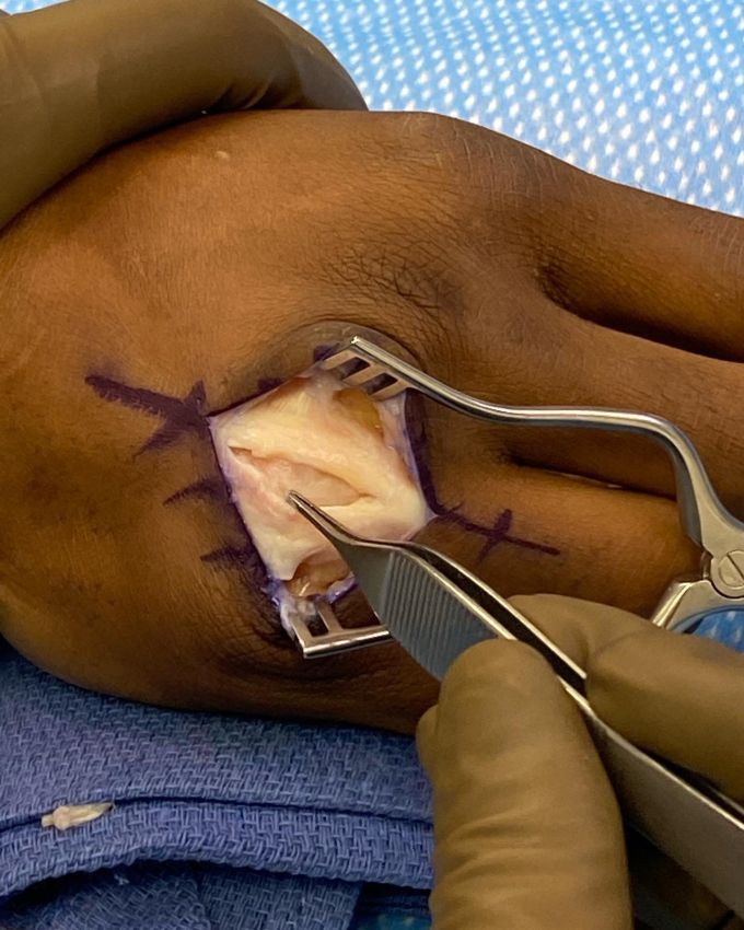 Камару Усман перенес операцию на правой руке